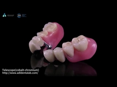 Teleskop İç Co-Cr ve Dış Co-Cr Metal Kompozit ile kısmen