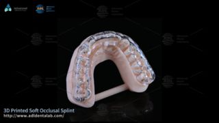 Bruksizm Konforu için Özel 3D Baskılı Splint