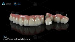 PFZ Dental Kronlar Doğal Güç ve Hassas Uyum