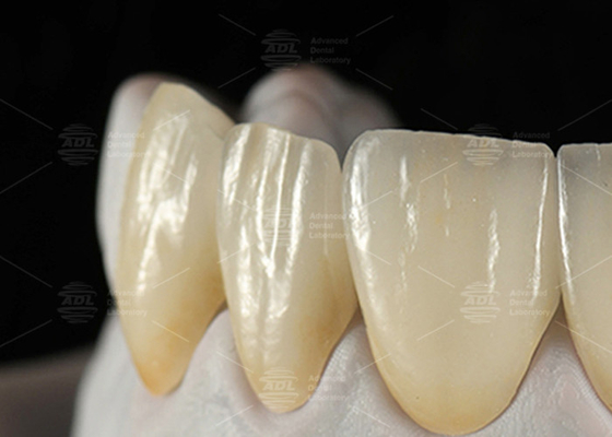 satın al 0.3mm-0.7mm Feldspathic EMAX Keramik Finerler Doğal Estetik Emax Diş Finerleri Çevrimiçi üretim