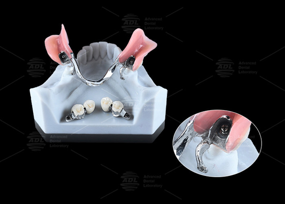 satın al 0.1mm Tolerans CEKA REVAX Bağlantı Titanyum 3mm Dikey Açıklık Çevrimiçi üretim