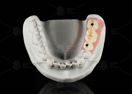 satın al Döşeme tutulmuş Titanyum Custom Abutment Porselen Zirkonya'ya Erimiş Çevrimiçi üretim