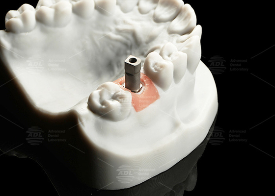 satın al Kesin Titanyum Dijital İmplant Tarama Vücudunun Cad / Cam için kum püskürtülmüş yüzeyi Çevrimiçi üretim