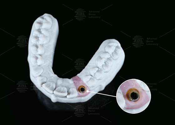 satın al İç Hex Özel Titanyum Abutment vida Çimento Değişen Şekil Korunmuş Çevrimiçi üretim