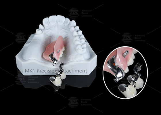 satın al MK1 Precision Attachment Çıkarılabilir Kısmi Diş Dişleri Çevrimiçi üretim