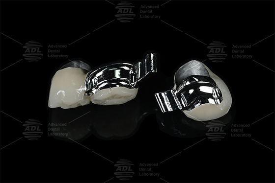 satın al Çin Diş Laboratuvarı Ayarlanabilir Hasta Özel Anahtar Yuvası Hassas Bağlantı Parçası PFM ile Çevrimiçi üretim