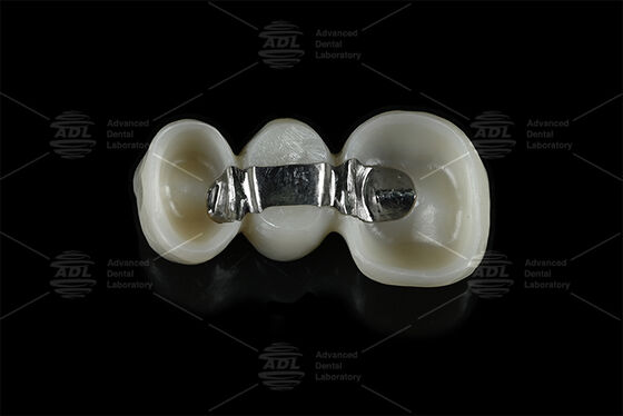 satın al Dental implant çerçeve çözümleri sağlayan freze zirkonya ile birleştirilmiş özelleştirilebilir güçlendirme titanyum çubuğu Çevrimiçi üretim