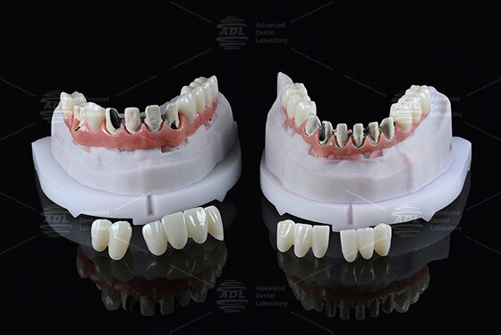 satın al Çin Diş Laboratuvarı Titanyum Tam Ark Hibrit Köprü, Anında Yüklemeli A1 Renk Malong Tasarım Vidalı Tutulan Cad/Cam Çevrimiçi üretim