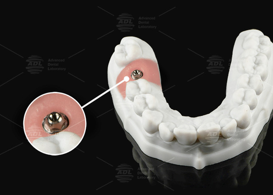 Gümüş Altın Titanyum Tek veya Çok Birimli Protetik Platform için Çok Birimli Abutment
