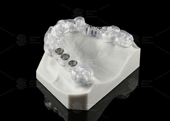 Özel Yapılmış Şeffaf Diş İmplantı Çözümü Cerrahi Stent Ergonomik Tasarım
