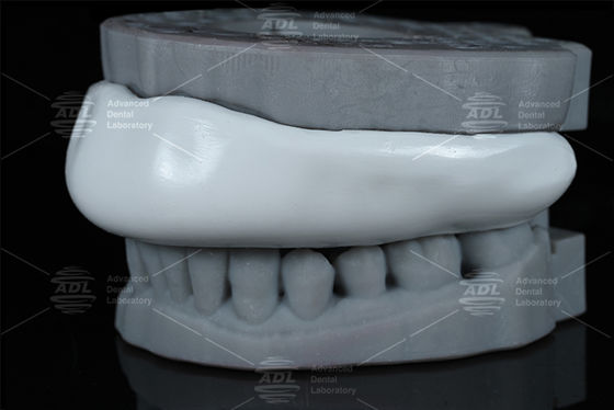 Konforlu Occlusal Splint Sport Guard Bite Splint Tasarımı Temizlenmesi Kolay Diş Kırpmak İçin Konforlu Koruyucu Cihaz