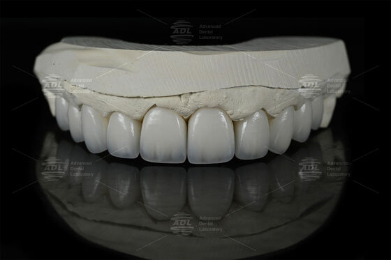 0.3mm-0.7mm Feldspathic EMAX Keramik Finerler Doğal Estetik Emax Diş Finerleri