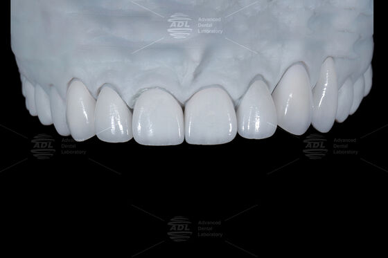 Natural Tooth Color Ceramic Feldspathic Veneer For Anterior And Posterior Teeth